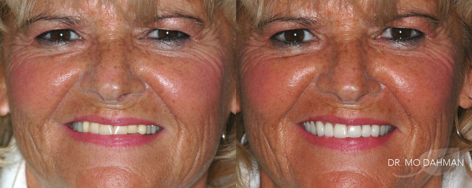 A woman's before and after photos with dentures