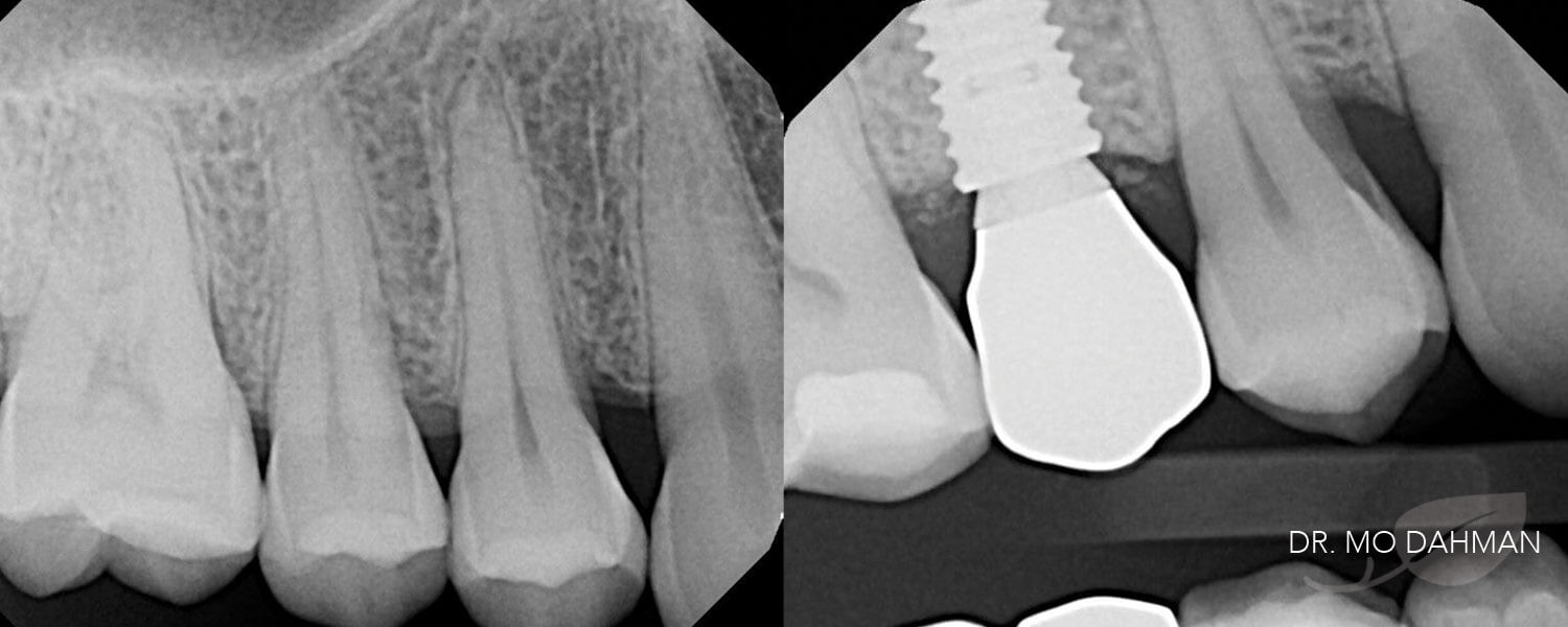 Before and after b/w x-ray photos of an implant