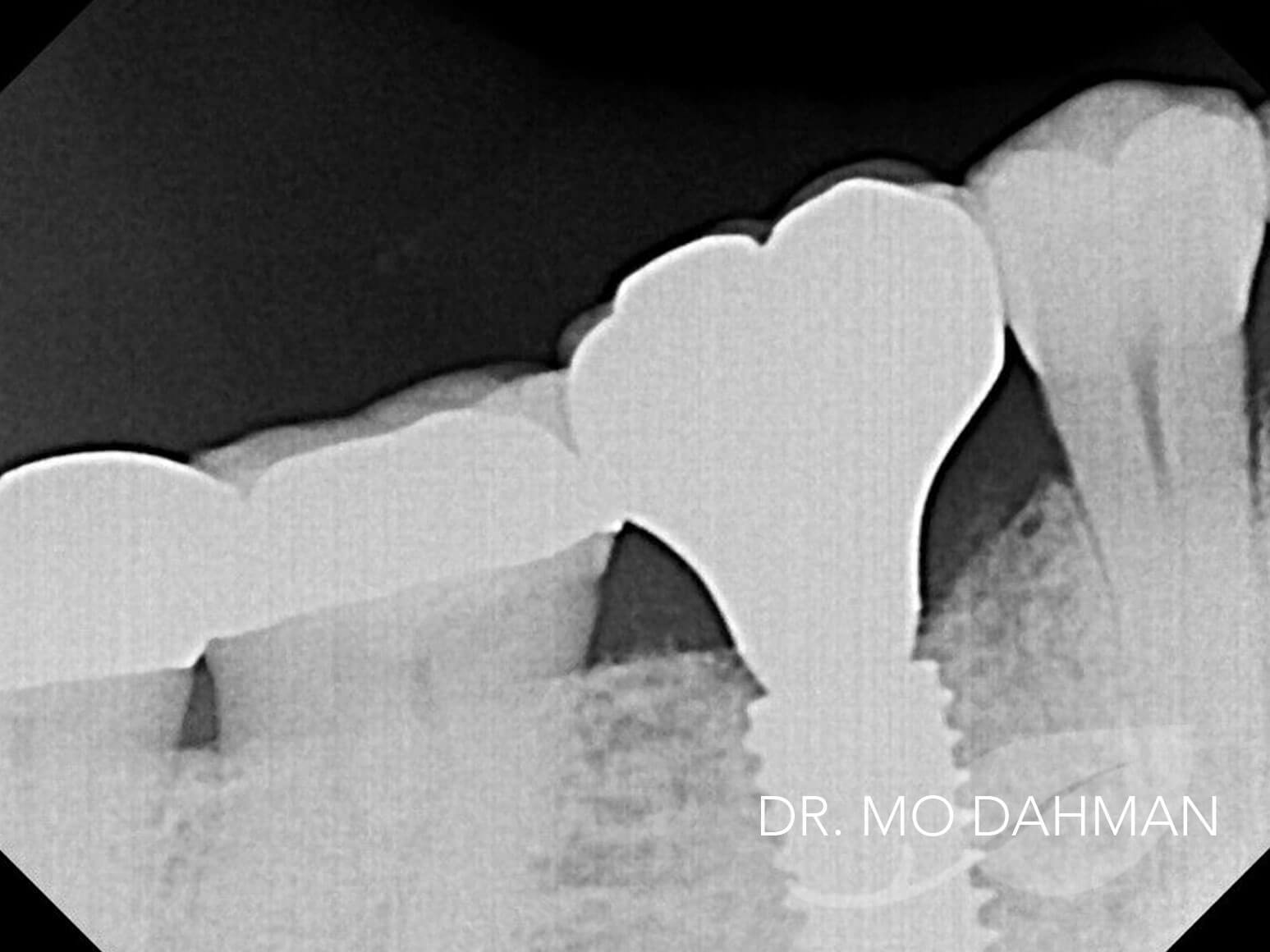 Case 02 xray after