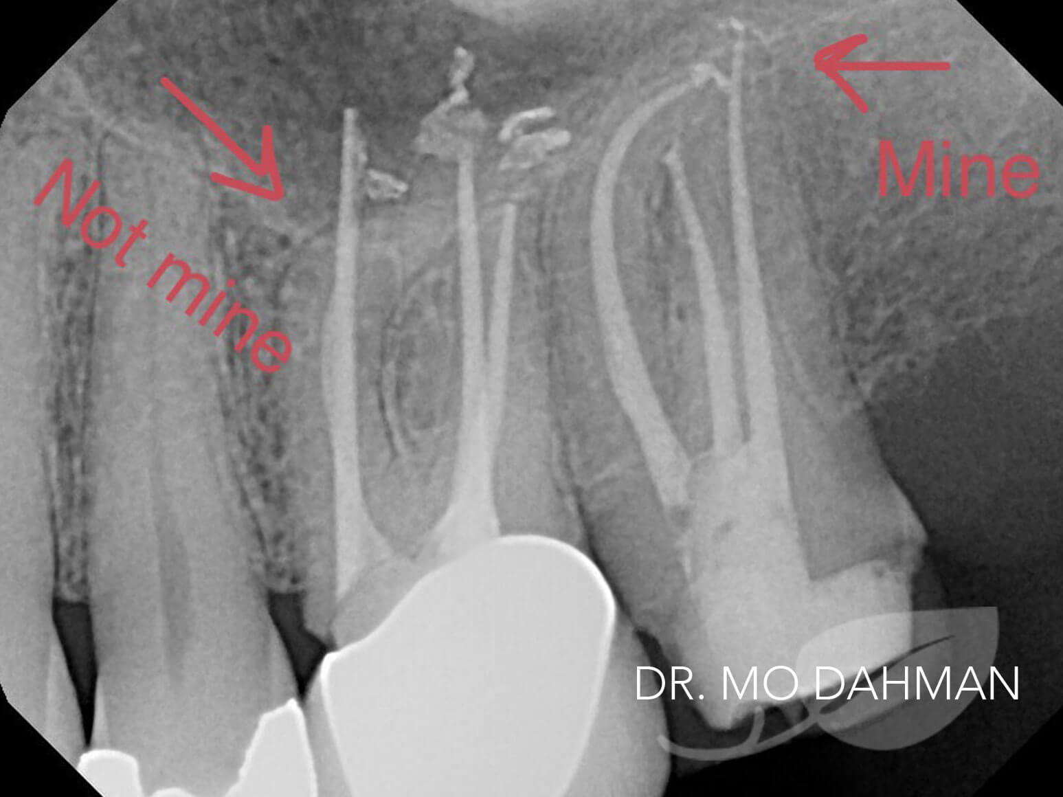 Case 17 xray after