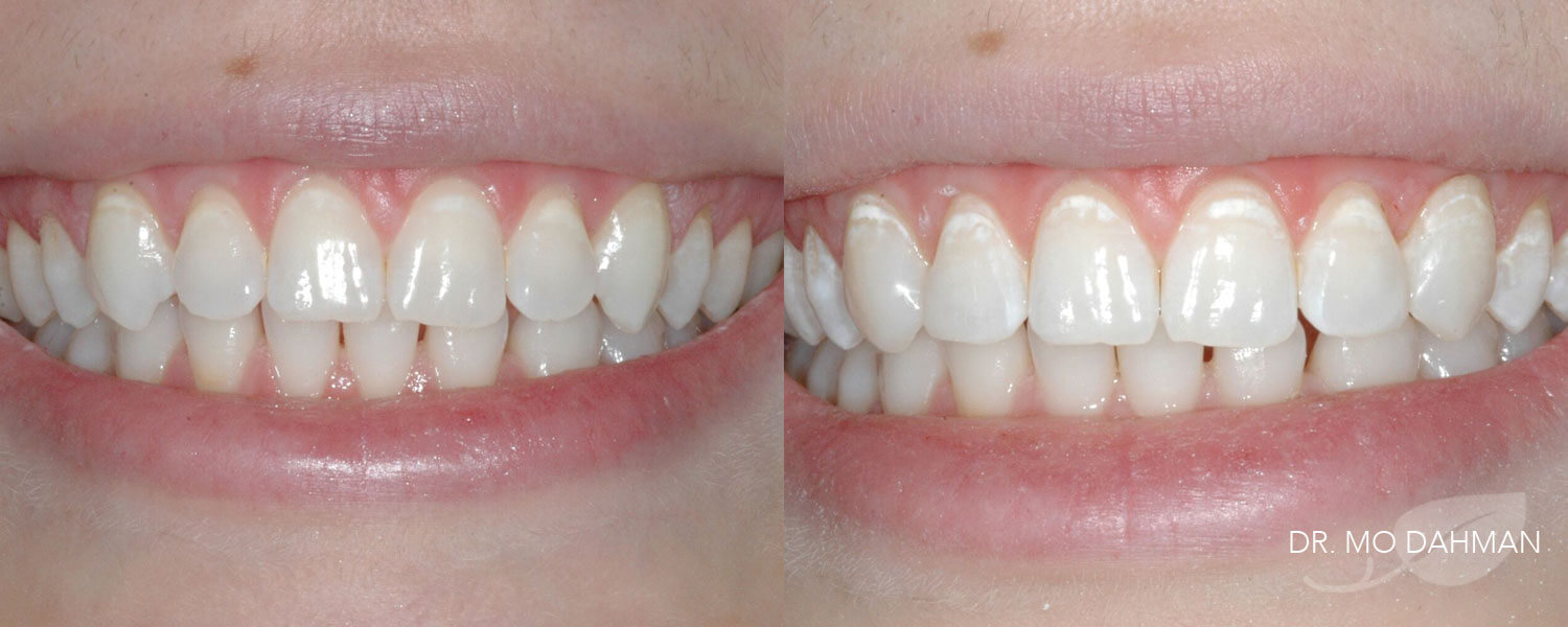 A before and after set of bonding treatment