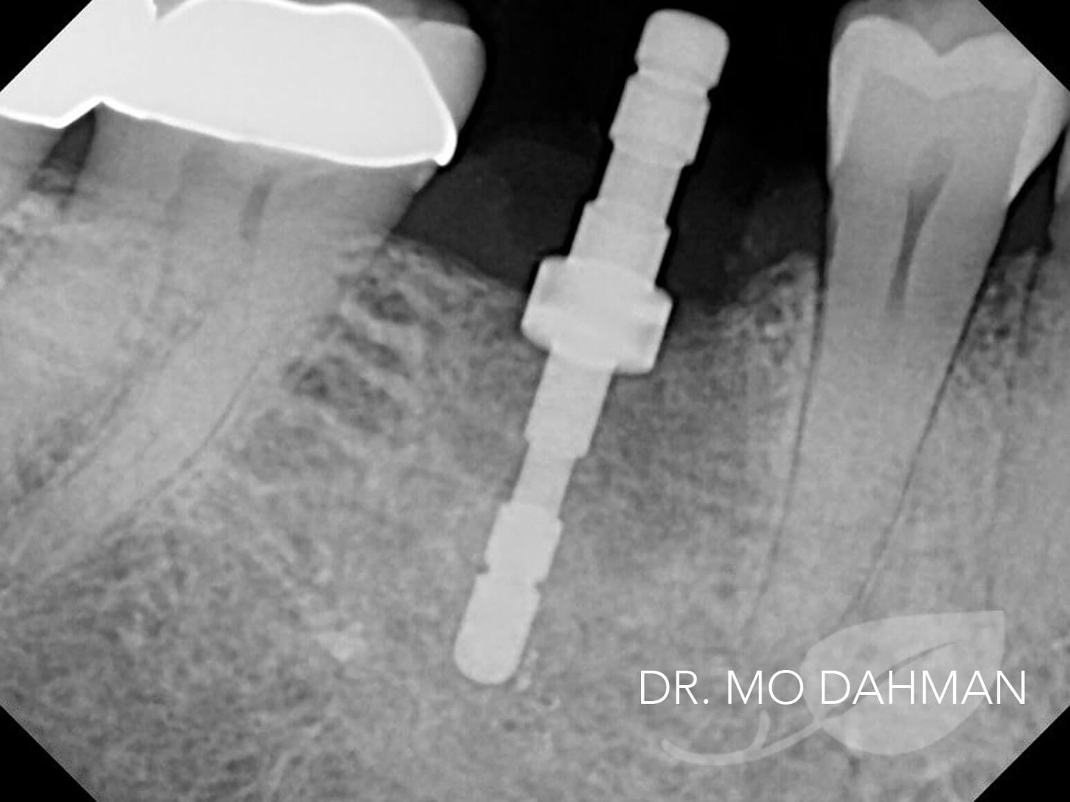 Case 02 xray progress with a post