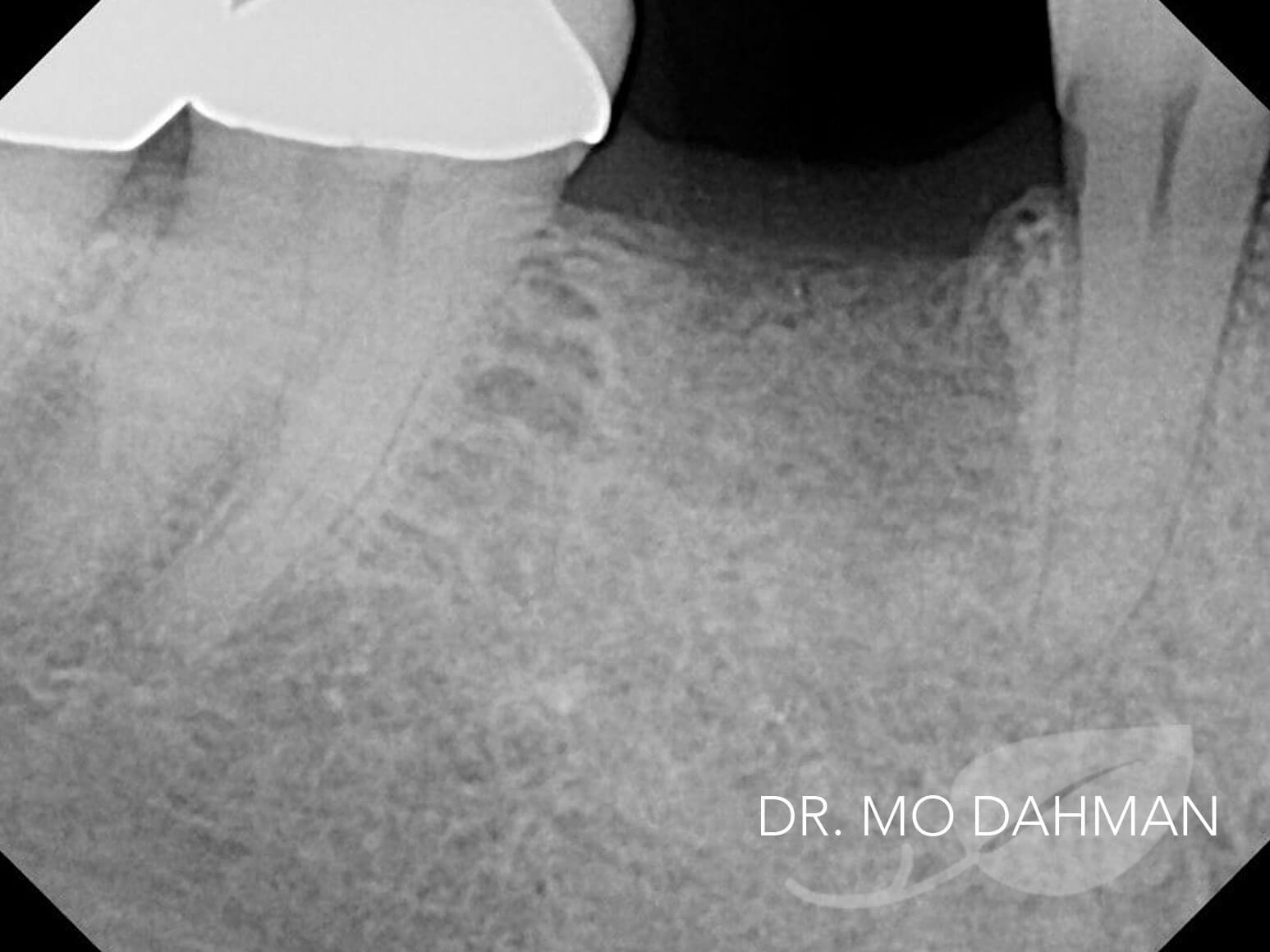 Case 02 xray process with a gap