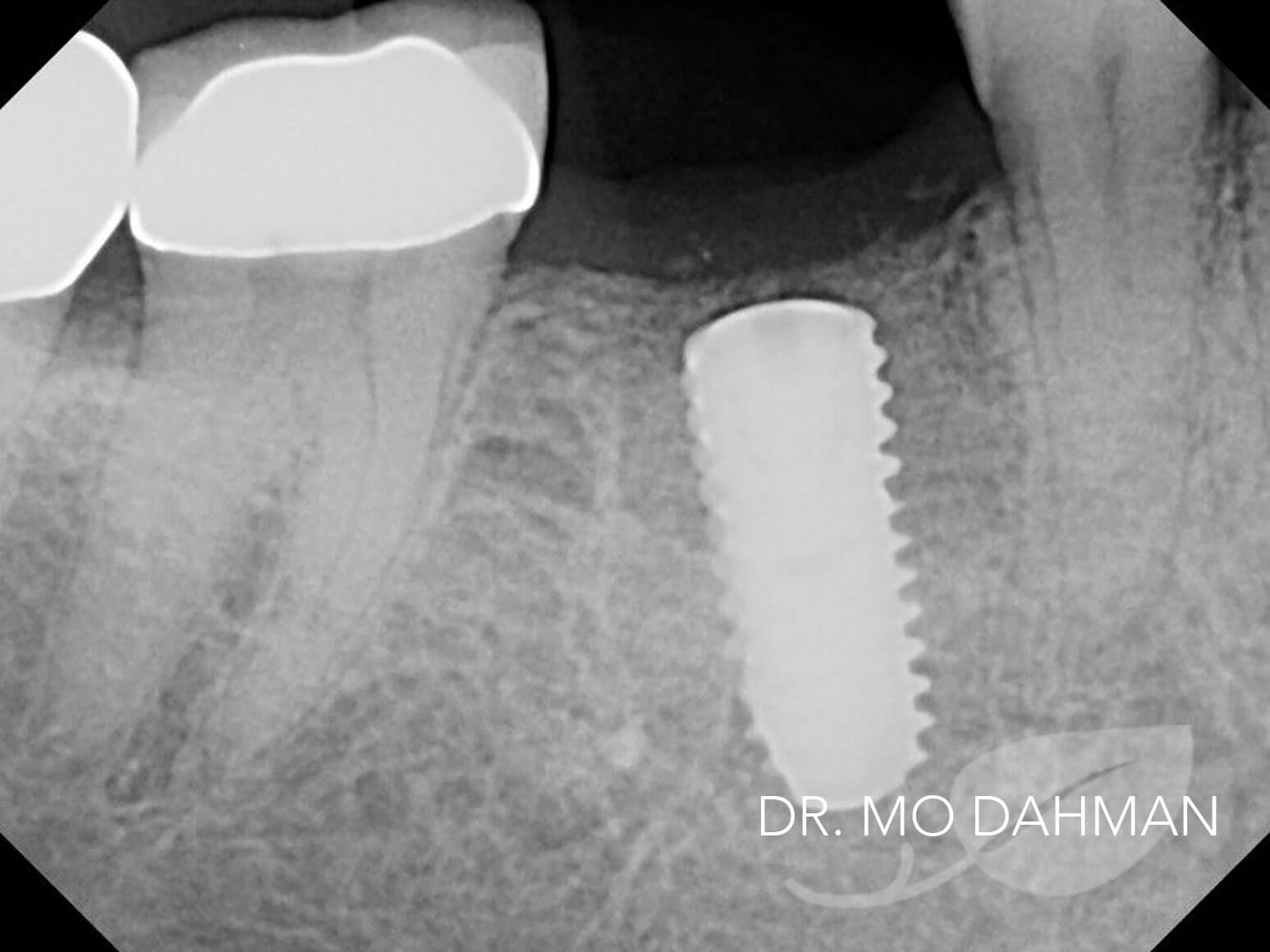 Case 02 X-ray in progress