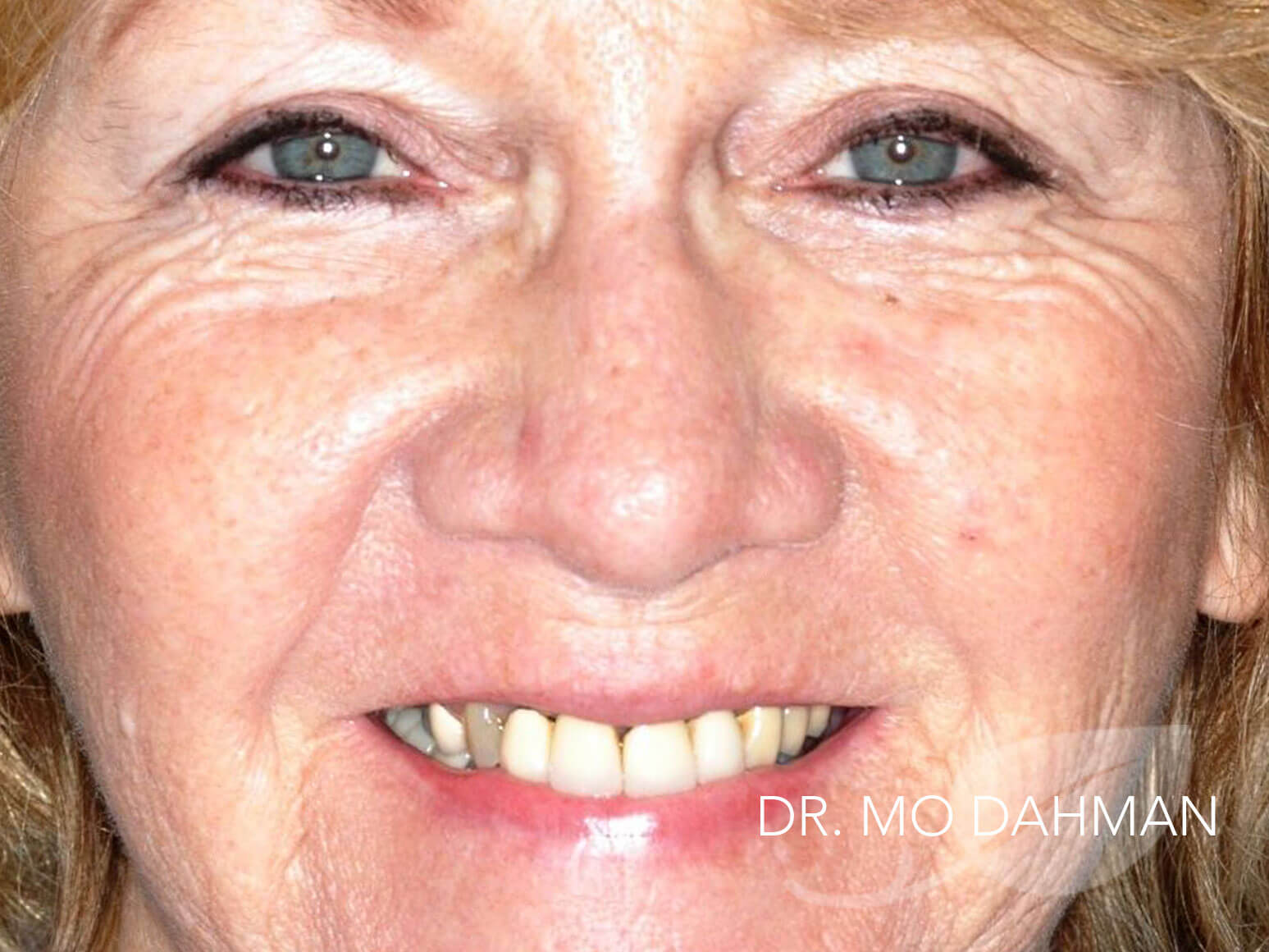 Case 06 full face smiling before treatment