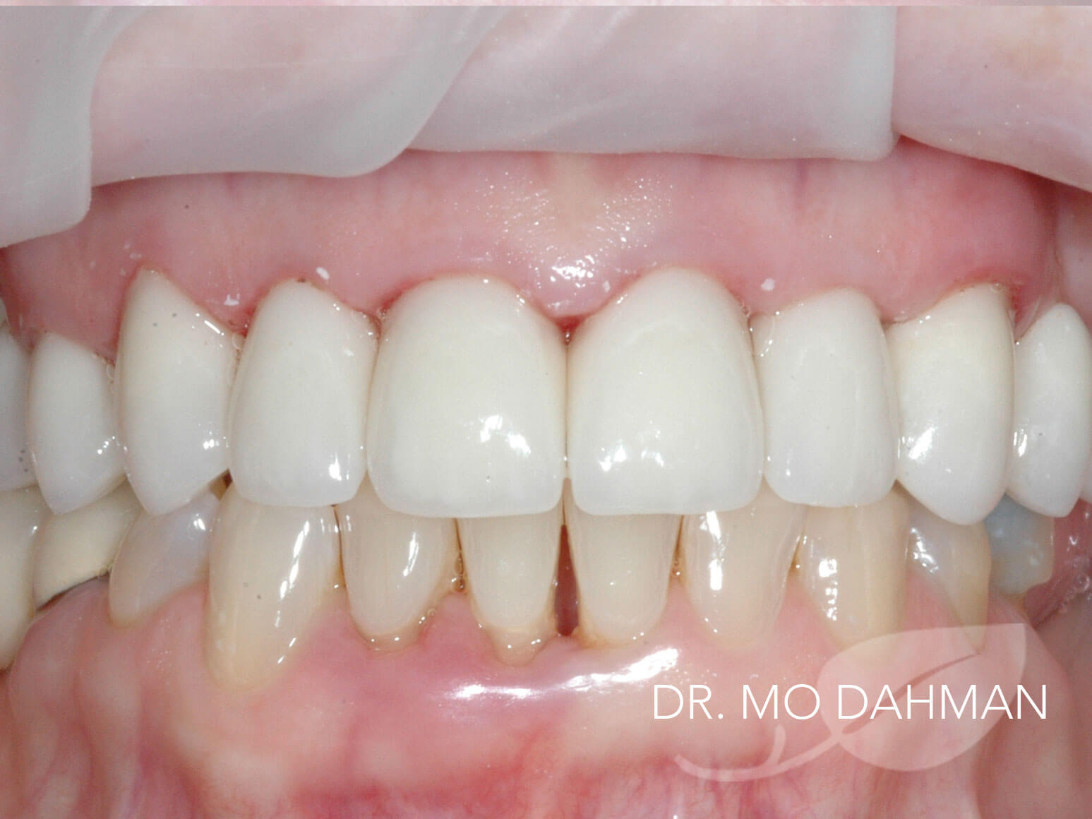 Case 06 retracted smiling after treatment
