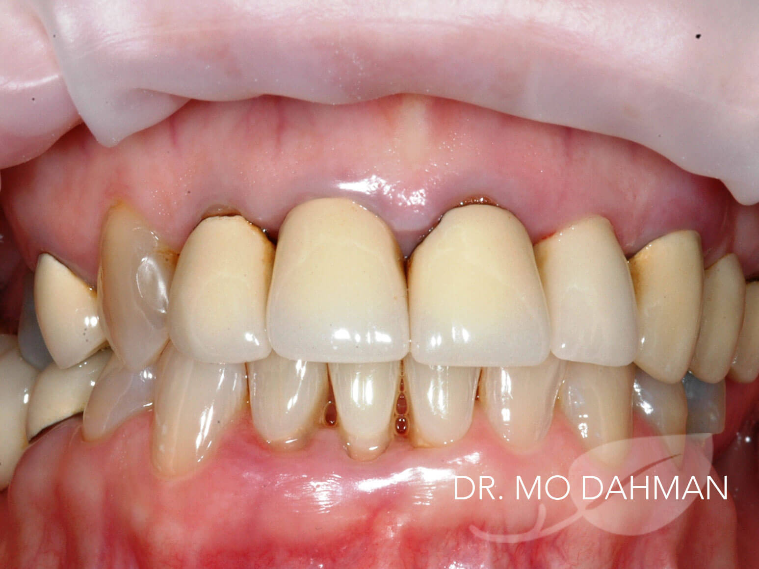 Case 06 retracted smiling before treatment