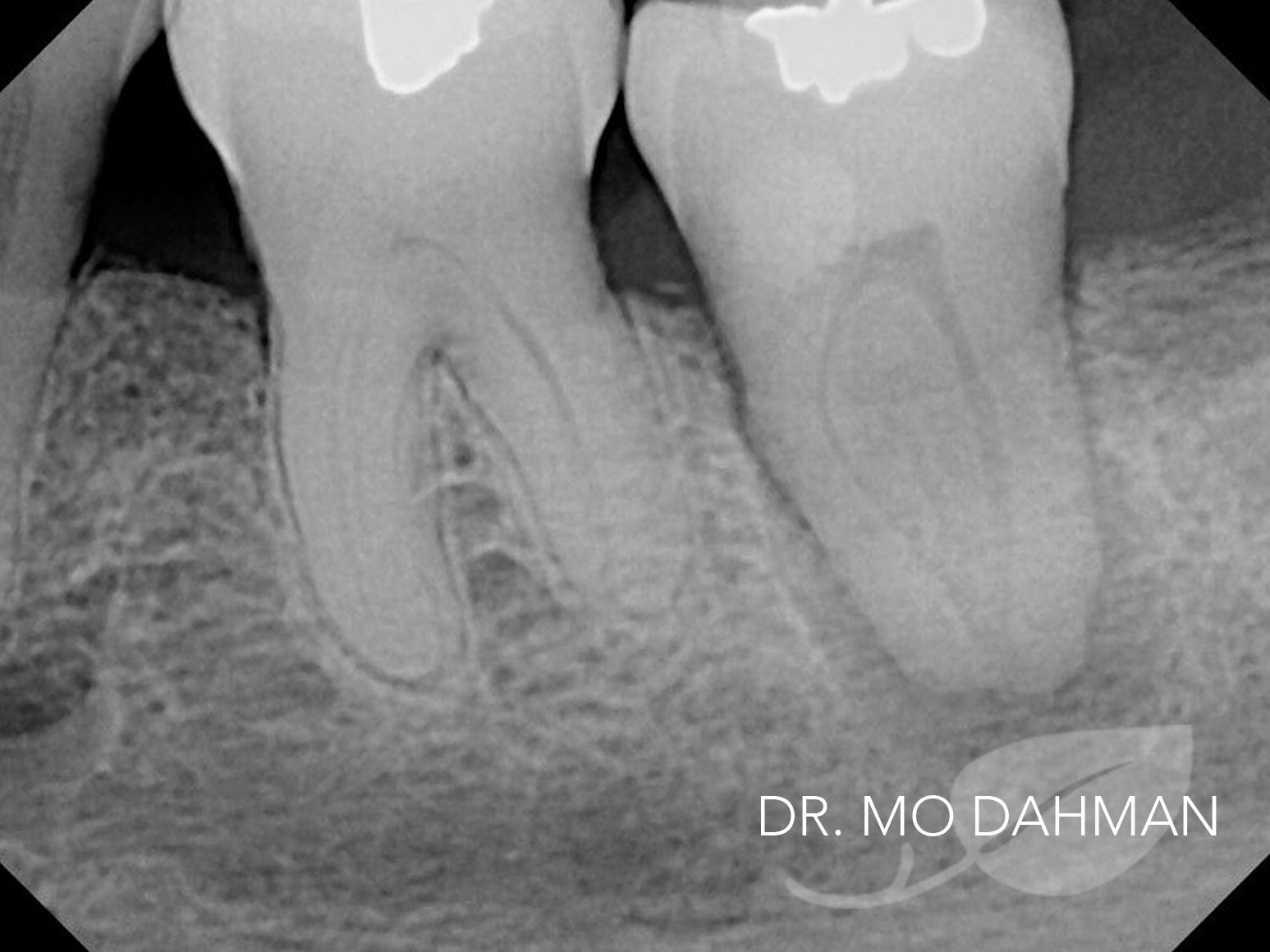 An X-ray of case 08 in progress