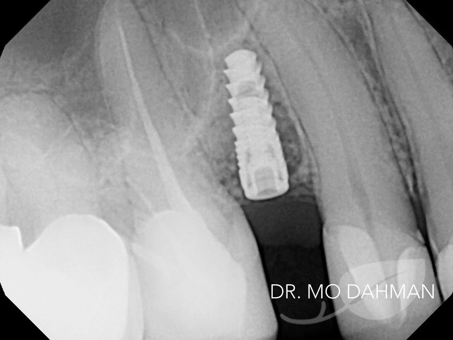 An X-ray of case 09 in progress