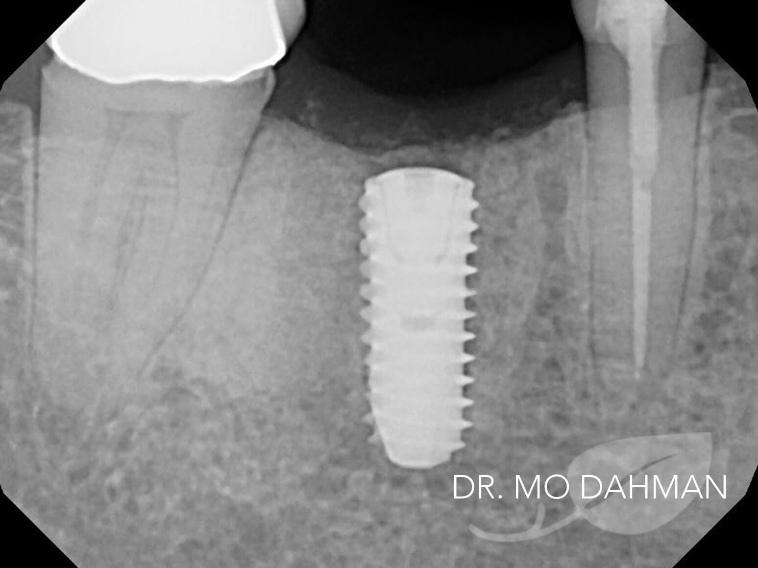 An xray of Case 11 in progress