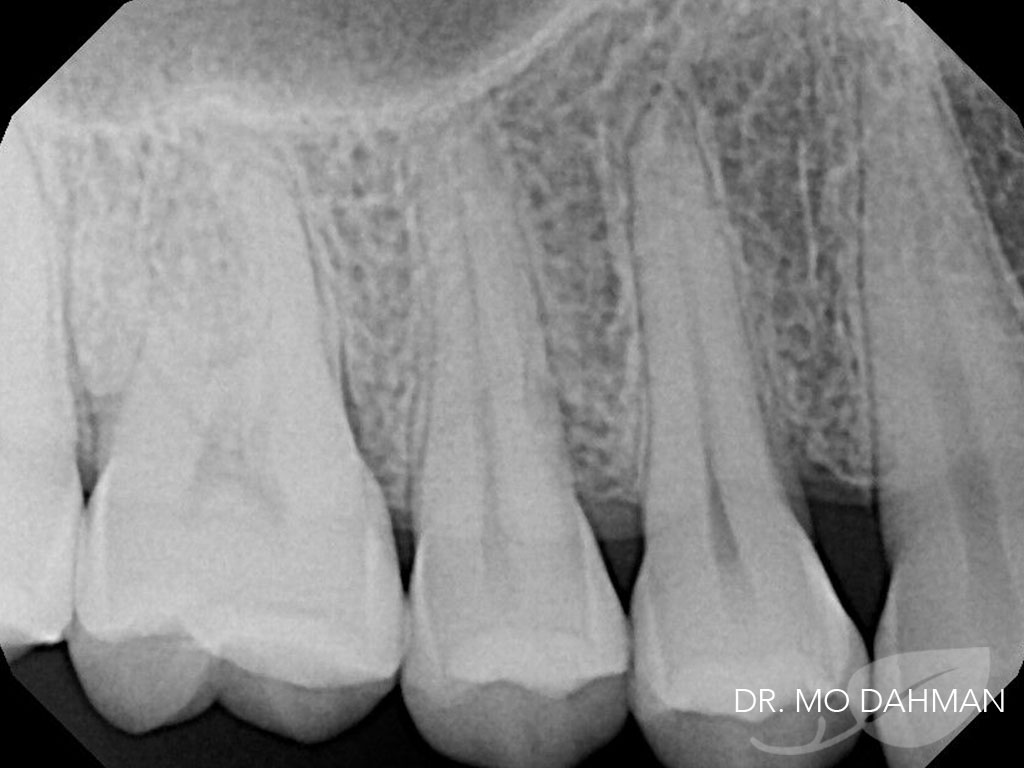 An x-ray o case 23 before treatment