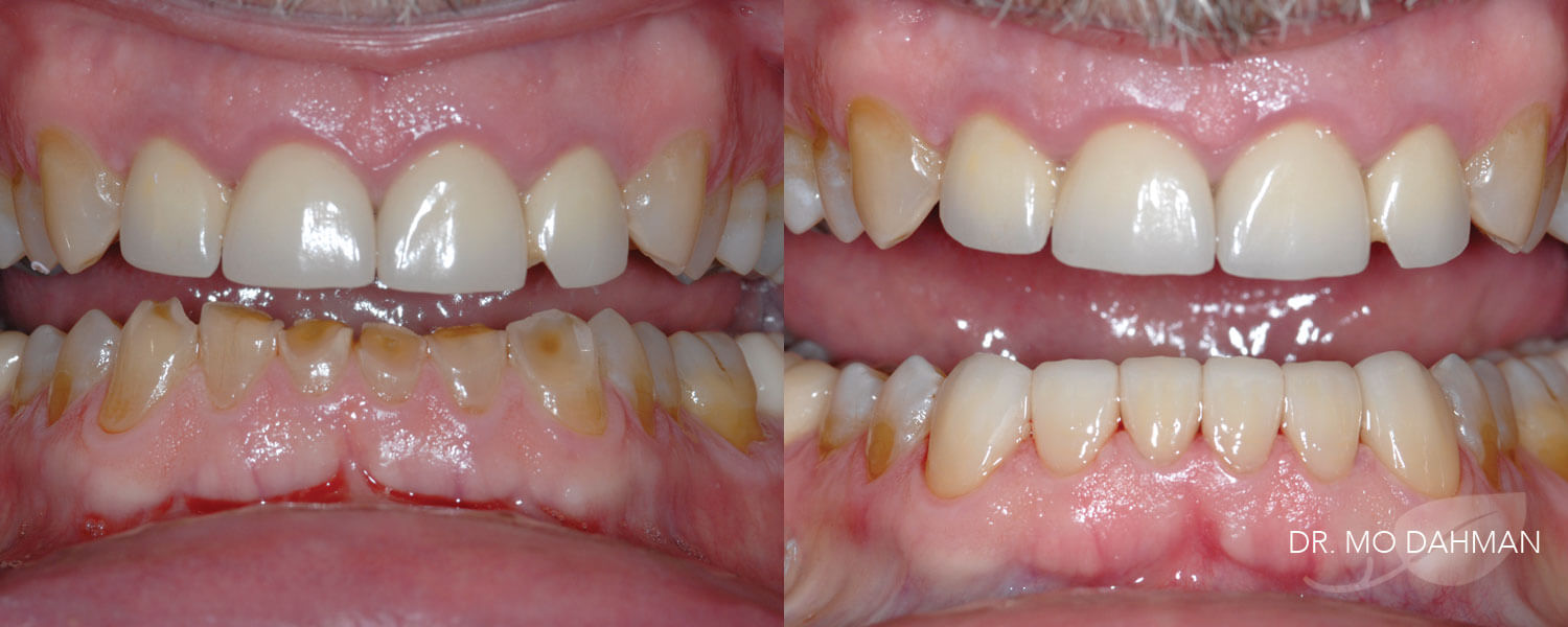 Before and after photos of a row of teeth with crowns