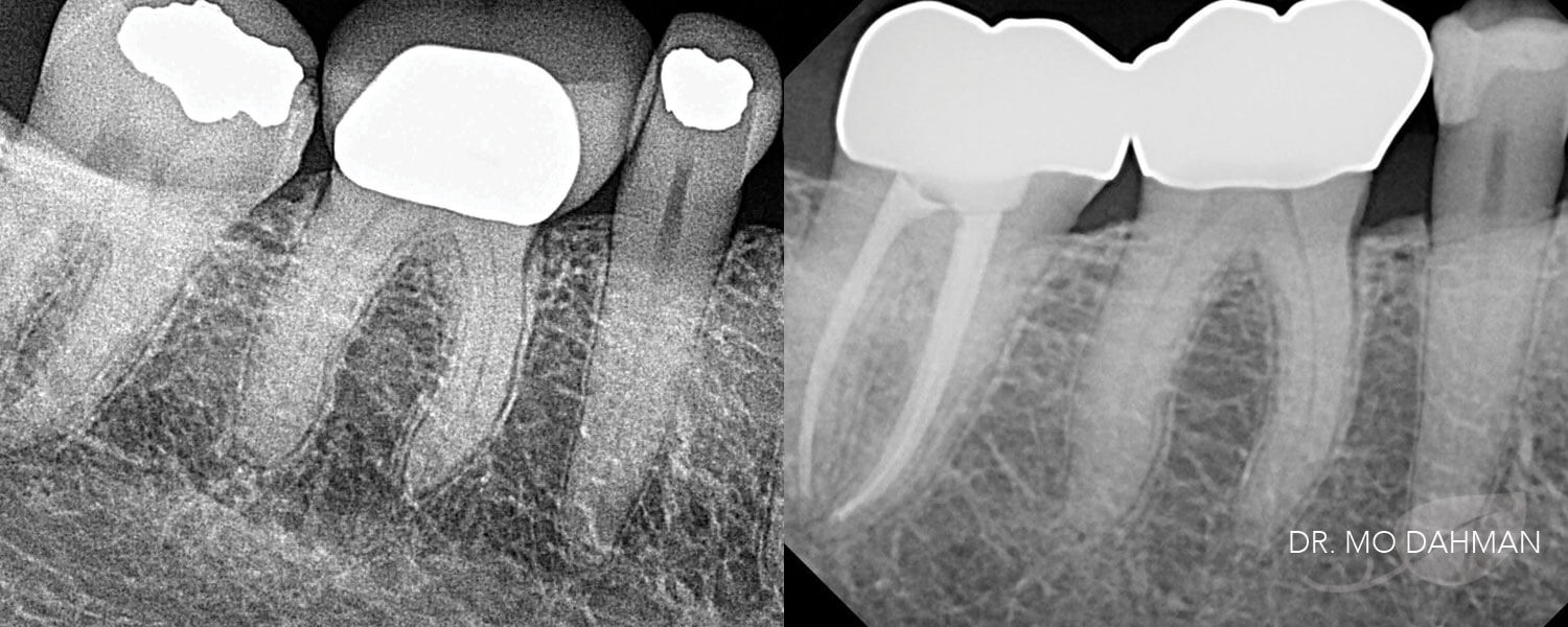 After and before x-ray photos of teeth with crowns