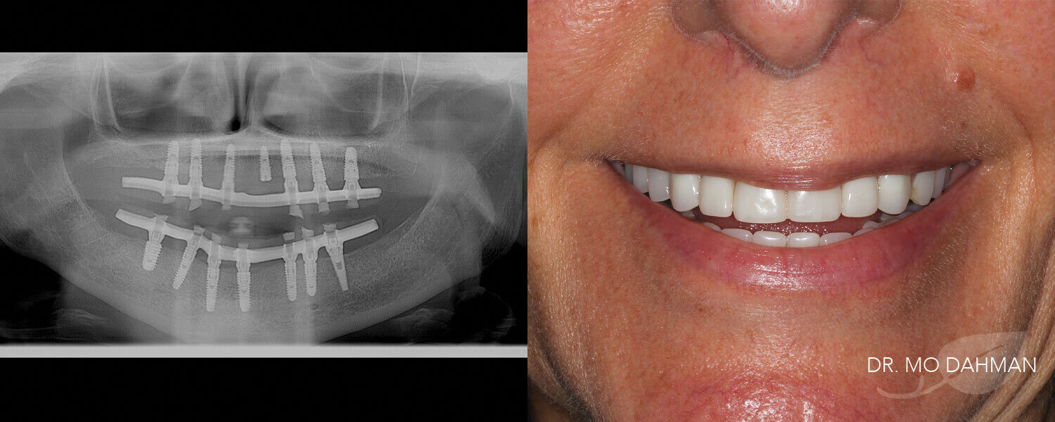 Photos of an x-ray and a man smiling with new dentures