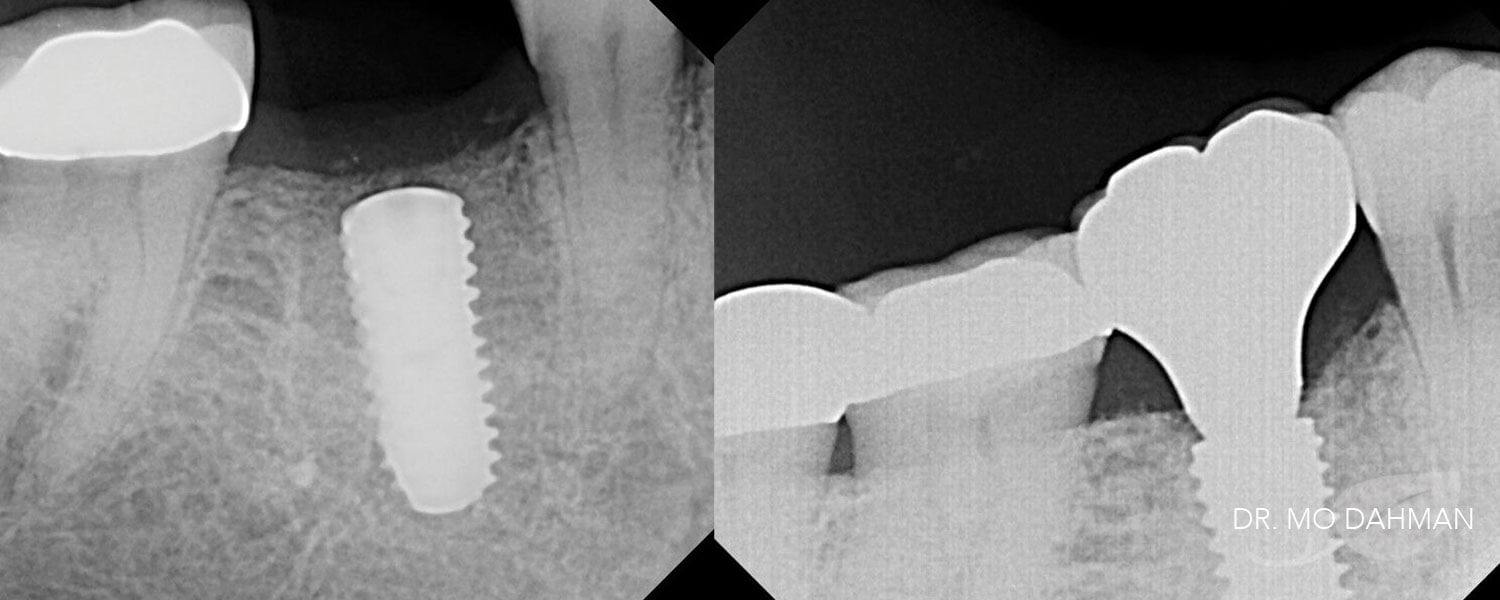 Before and after x-ray photos of a row of teeth with implants