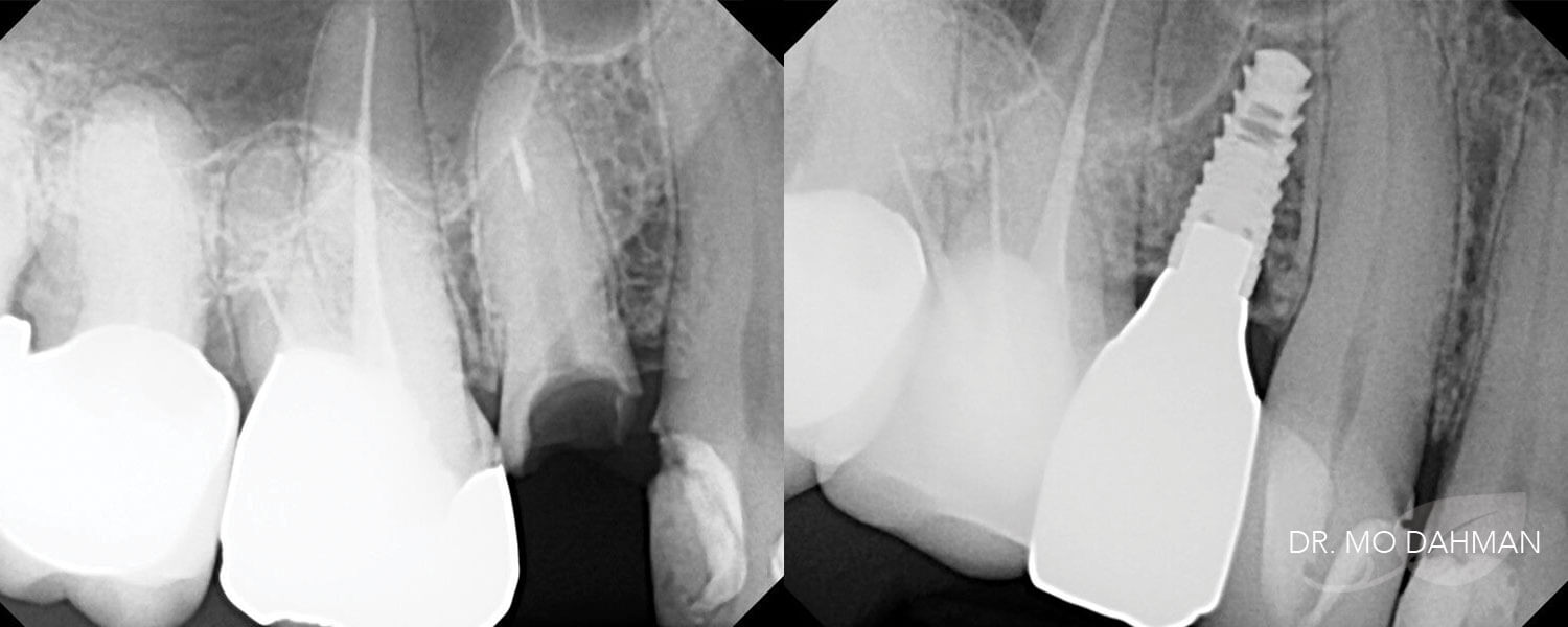 Two X-rays showing before and after tooth implants