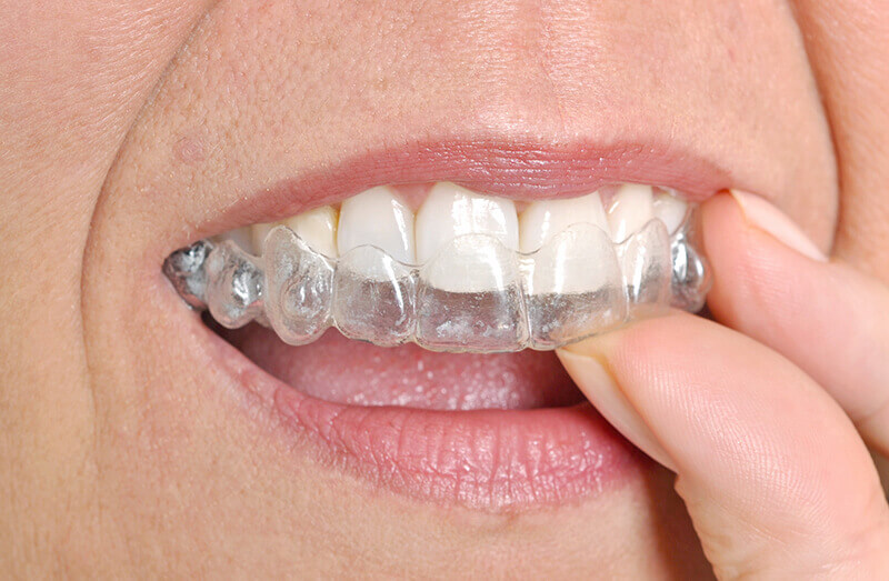 A person putting in an Invisalign retainer