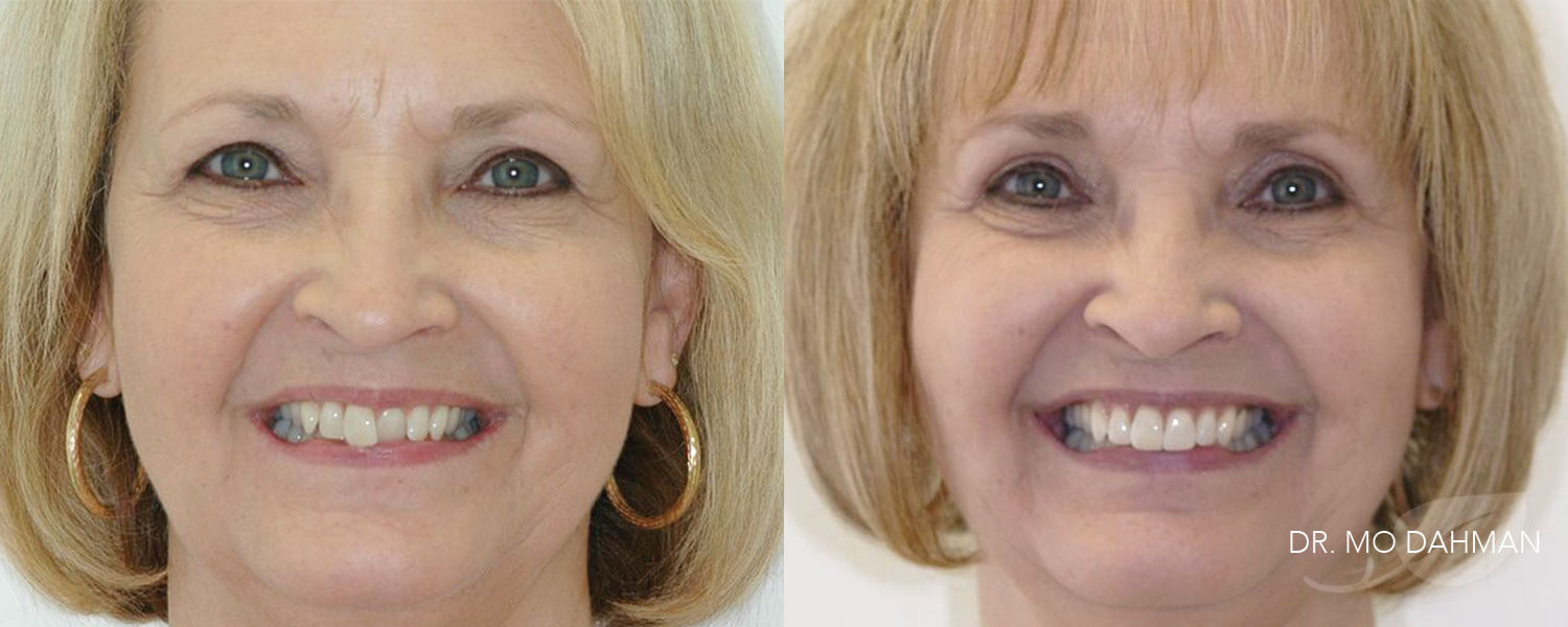 Before and after photos of a woman smiling with Invisalign