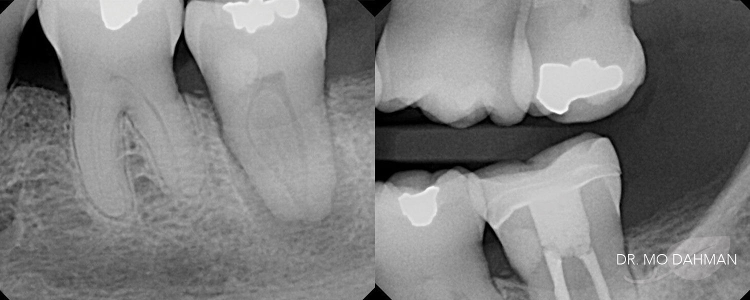 Before and after x-ray photos of a root canal and crown