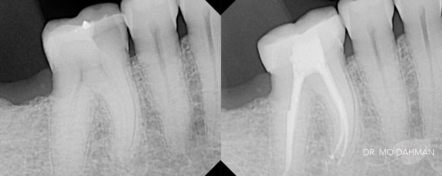 Before and after x-rays of root canals