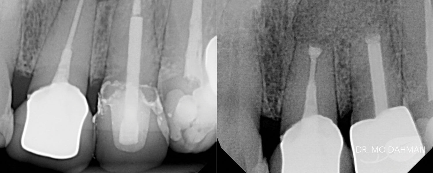 Xray photos of a root canal both before and after