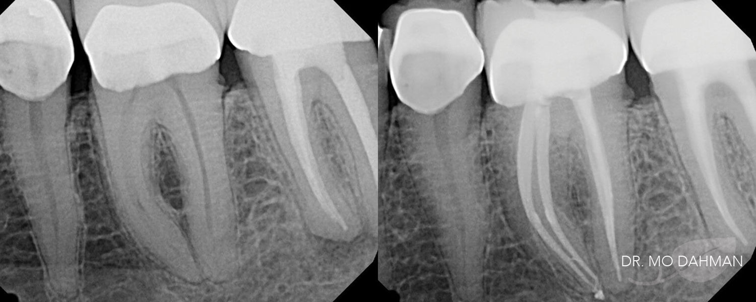 A before and after set of X-rays showing root canals