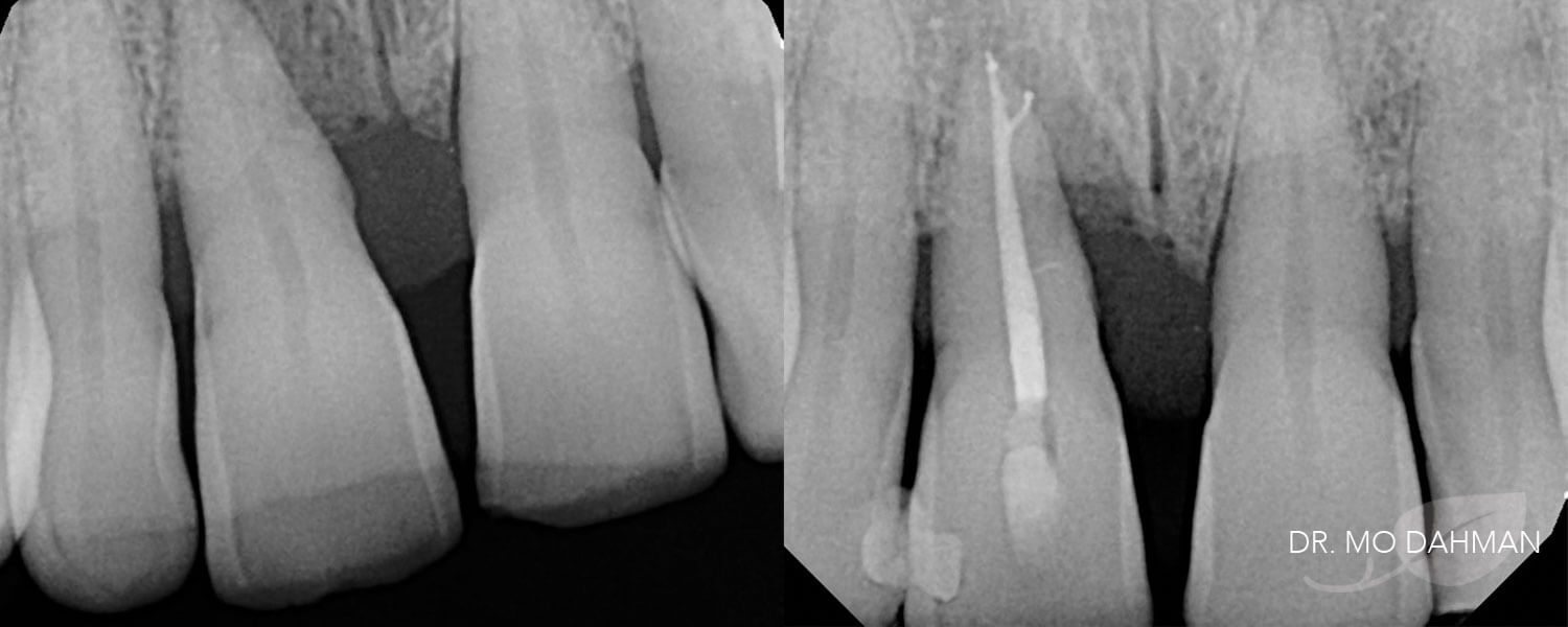 Before and after x-ray shots of a root canal