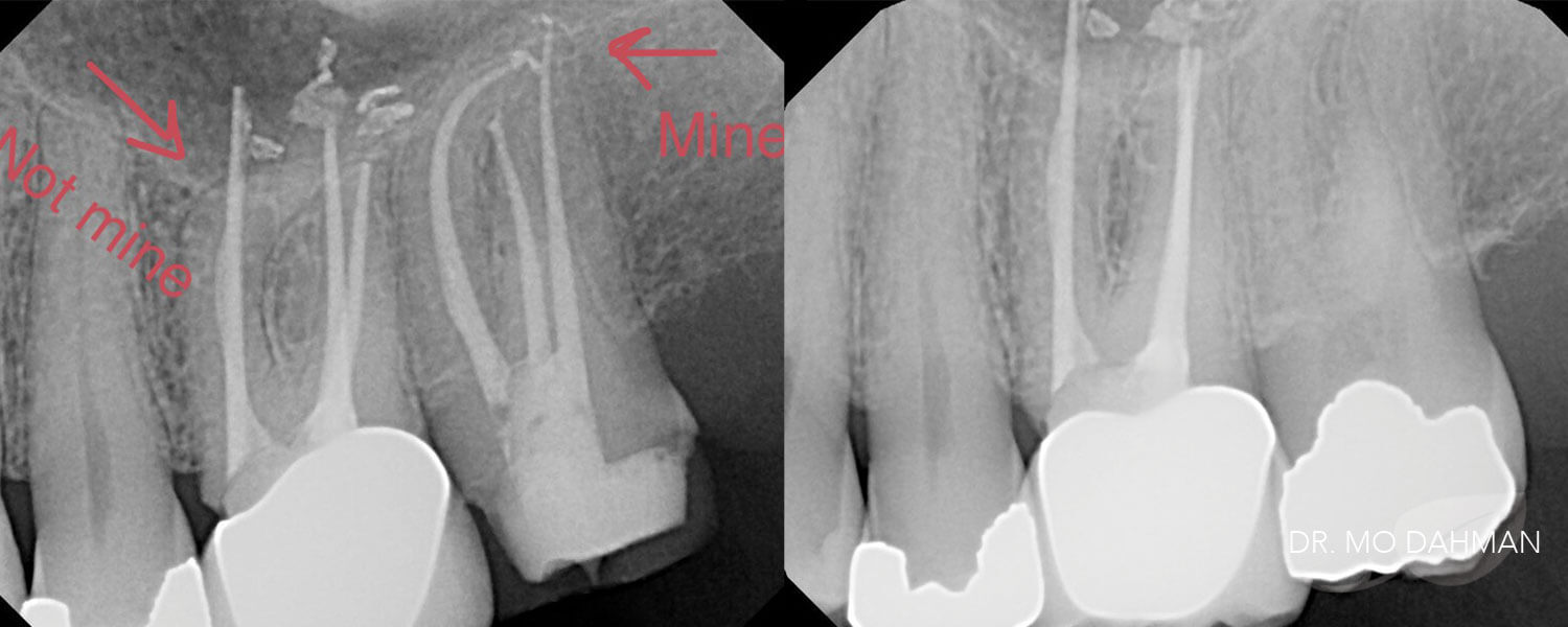 A couple xrays comparing root canals