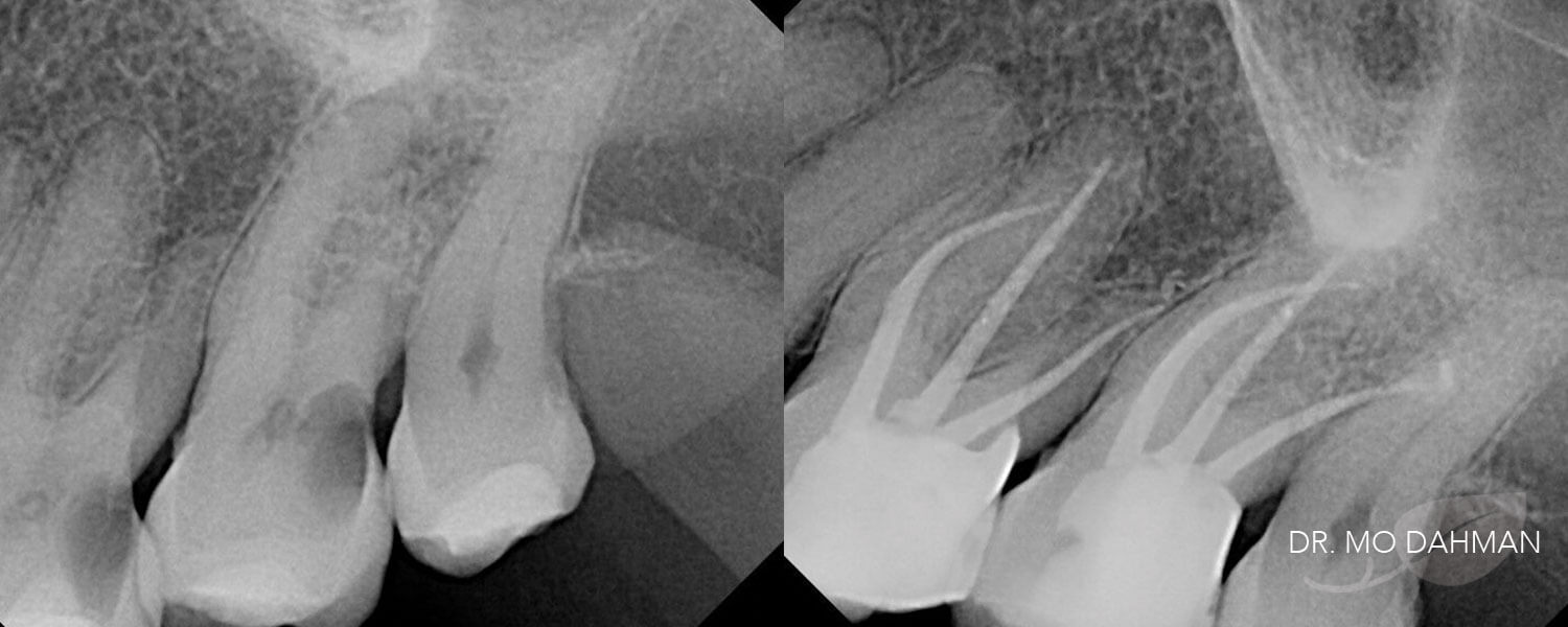 Before and after x-ray set of photos of a root canal