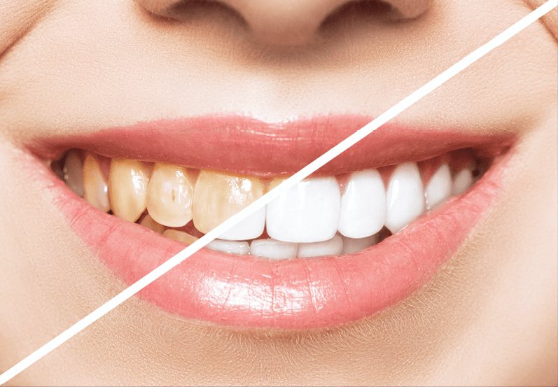 A before and after photo of a woman smiling with a diagonal white line