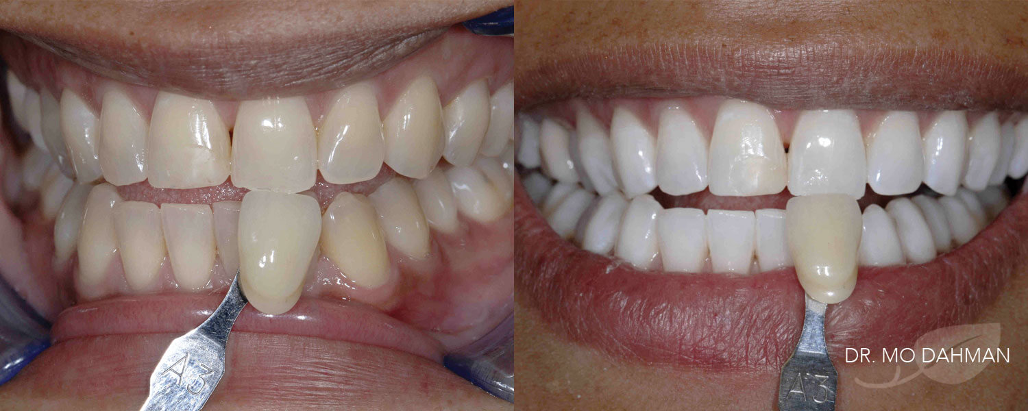 A set of photos showing the results of teeth whitening