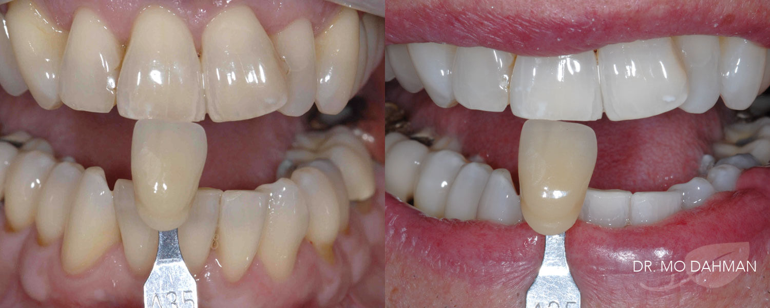 Before and after photos of the results of a whitening procedure