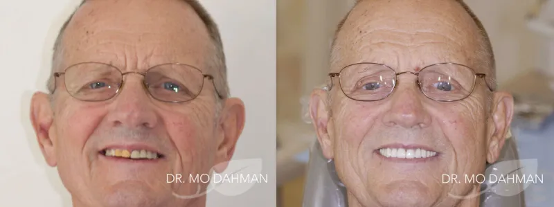 Before and after photos of a man with new crowns and bridges