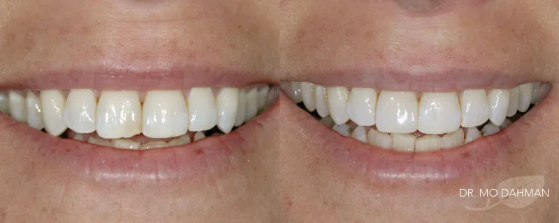 A before and after photo of a man smiling with bonding