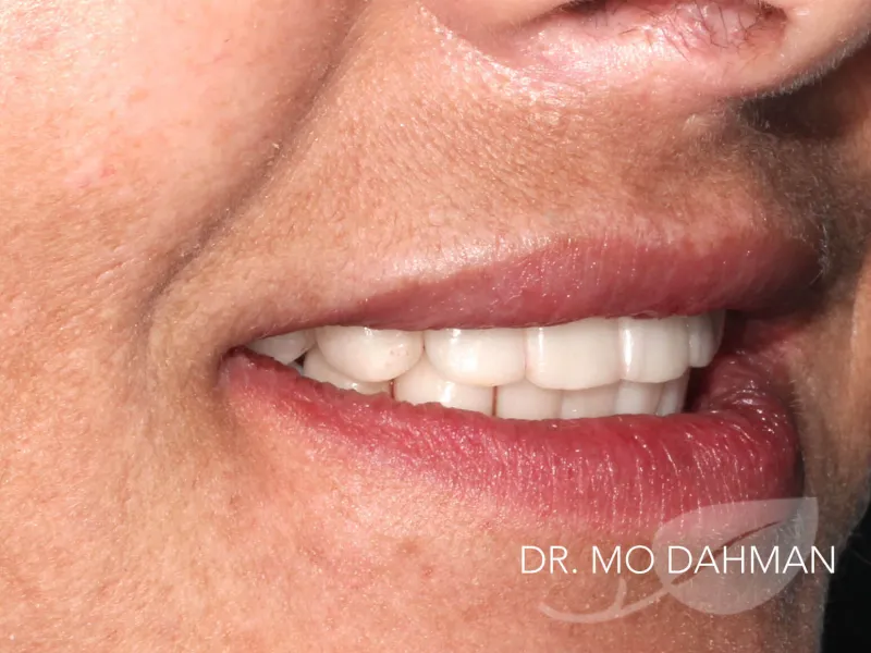 A close up of Case 03 smiling after side view