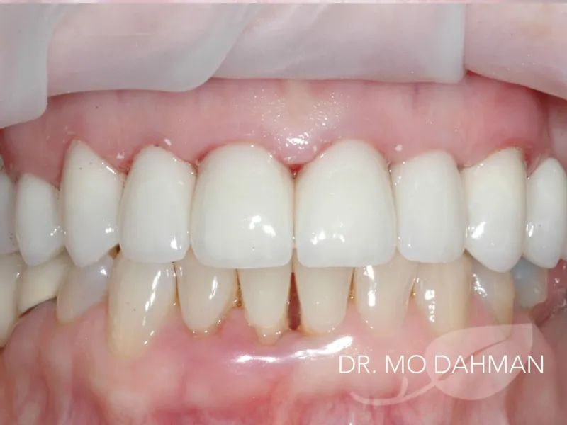 Case 06 retracted smiling after treatment