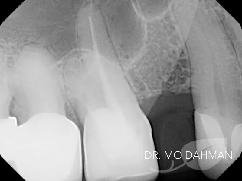 An xray of case 9 with a gap