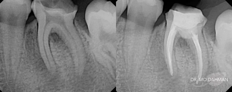 A set of before and after photos of children teeth X-rays