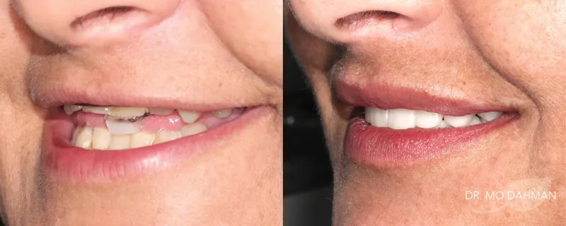 Before and after photos of someone with new crowns