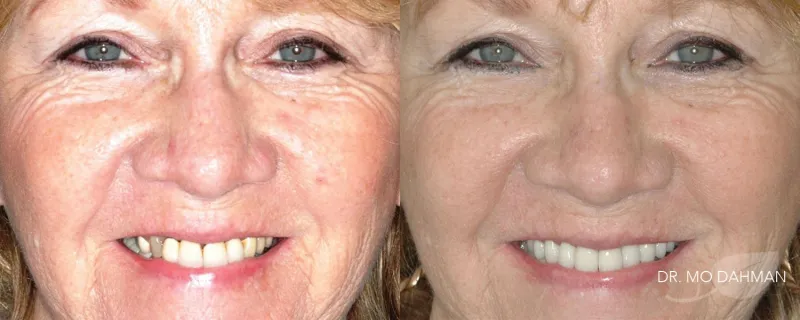 Before and after photos of a woman smiling with new crowns