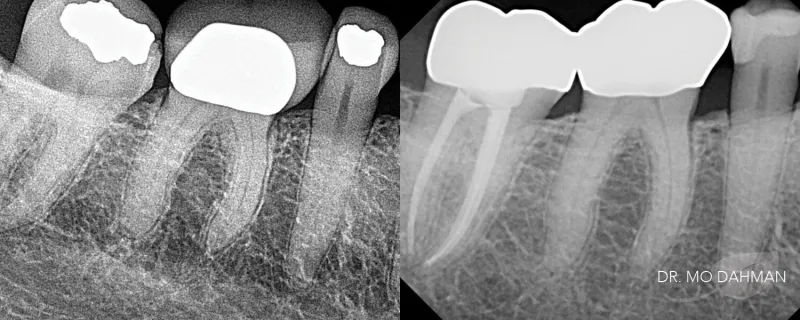 After and before x-ray photos of teeth with crowns