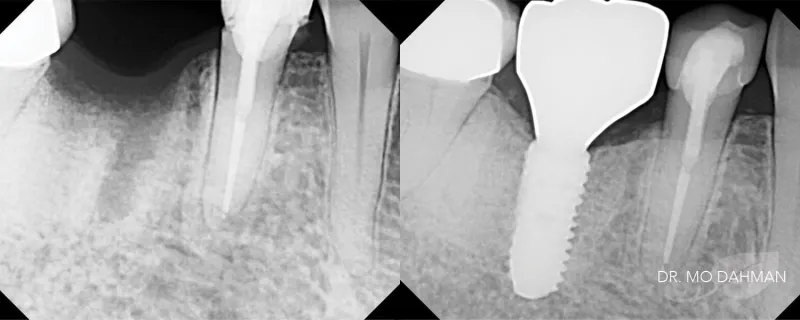 Before and after x-ray photos of implants